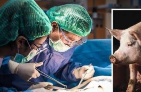 نجاح زرع كلية خنزير في جسم إنسان