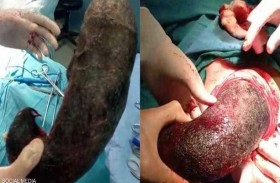 مفاجأة مرعبة داخل معدة مريضة 