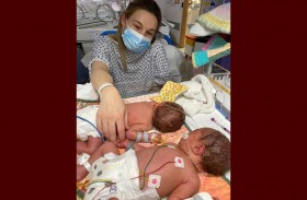 توأم معجزة تنجوان من عمليتين خطيرتين