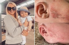 تعالج أكزيما طفلها بمرطب سحري