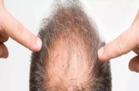 أول علاج موضعي للصلع يعيد نمو الشعر