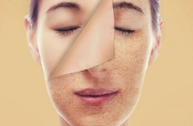 عـــــلاج الوجـــــه الجـــــاف