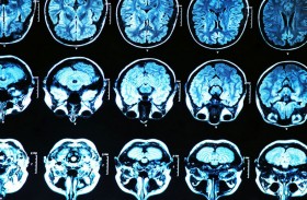 تجربة افتراضية لاختبار علاجين للزهايمر