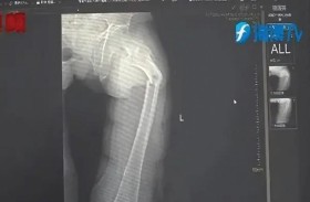 عطس فكسر عظام فخذه