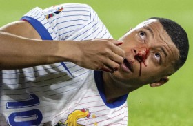 مبابي أصيب بكسر في أنفه ولا يحتاج إلى جراحة 