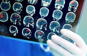 «خطأ طبي» يتسبب بوفاة طفل بورم في المخ