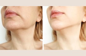 كيف يمكن للنساء التخلص من «ذقن الفراولة»؟