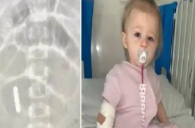 طفلة تفقد جزءاً من أمعائها بسبب مغناطيس لعبة