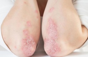 طبيبة تكشف العوامل المحفزة للصدفية