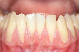 هل تنمو اللثة مرة أخرى بعد انحسارها؟