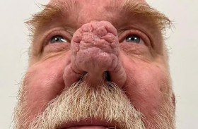 أنفه الضخم دفعه لعزلة اجتماعية