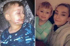 لصق أجزاء من وجه طفل ينجيه من الموت