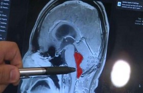 دودة في مخ رجل 10 سنوات