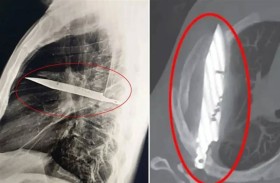 العثور على سكين مستقرة في صدر رجل 8 أعوام