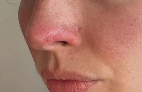 الوردية.. حالة جلدية تسببها حروق الشمس