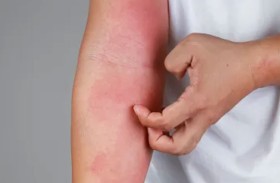 كيف نتعرف على حساسية الشمس؟