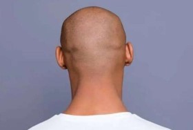 اكتشاف علاج ثوري للصلع والسر في السكر