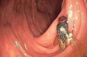 ذبابة حية تطن داخل أمعاء رجل