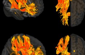 اكتشاف مناطق في الدماغ تتأثر بارتفاع ضغط الدم