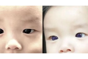 عينا رضيع تحولتا من البني إلى الأزرق