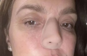 تعيش بأنف اصطناعي بسبب السرطان