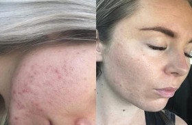 بودرة ثورية تقضي على حب الشباب