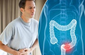 طريقة لتقليل خطر الإصابة بسرطان القولون