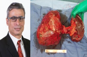 كليفلاند كلينك أبوظبي يعالج مريضة خمسينية من ورم سرطاني يزن 3.5 كجم