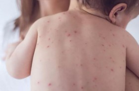 أعراض الحصبة الألمانية لدى الأطفال