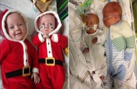 يولد ضعف حجم شقيقه التوأم بسبب حالة نادرة