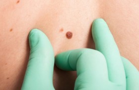 أعراض تشير إلى سرطان الجلد