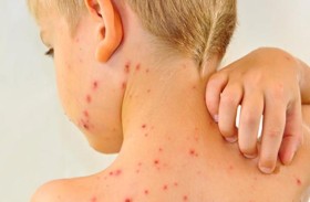 ارتفاع حالات الحصبة في الأردن