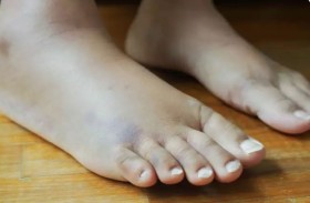 متى تقلق بشأن تورم قدميك؟