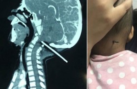 قضيب حديدي يخترق جمجمة رضيع