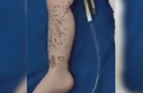 غضب واسع بالعراق بعد حرق طفلة بالأسيد