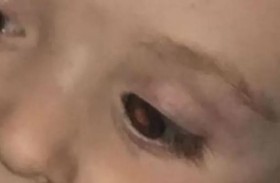 لاحظت وميضا في عين طفلها.. المفاجأة سرطان نادر