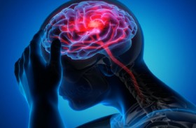 أعراض غير متوقعة للجلطة الدماغية