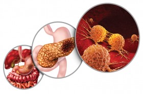 كشف أعراض سرطان البنكرياس التي تظهر قبل النوم